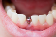 Как выбрать зубные имплантаты