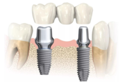 Типы зубных имплантатов и их стоимость